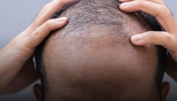 Estévia: composto pode aumentar crescimento capilar em 67% em casos de calvície