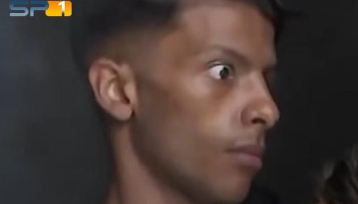 Jovem intoxicado por Metanol perde 10kg e está cego; VEJA VÍDEO