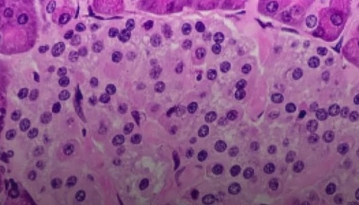 Resistência à insulina: sintomas da condição silenciosa pré-diabetes